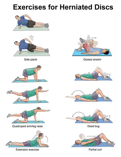 Herniated Disc: Exercises .